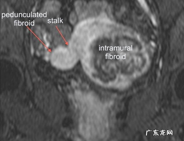 子宫肌瘤患者需要注意哪些忌口?