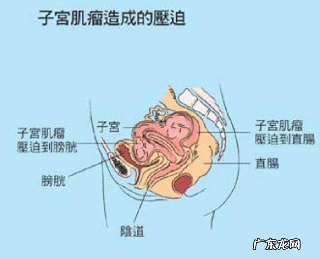 子宫肌瘤患者需要注意哪些忌口?