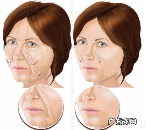 减肥后脸上法令纹好明显怎么办？