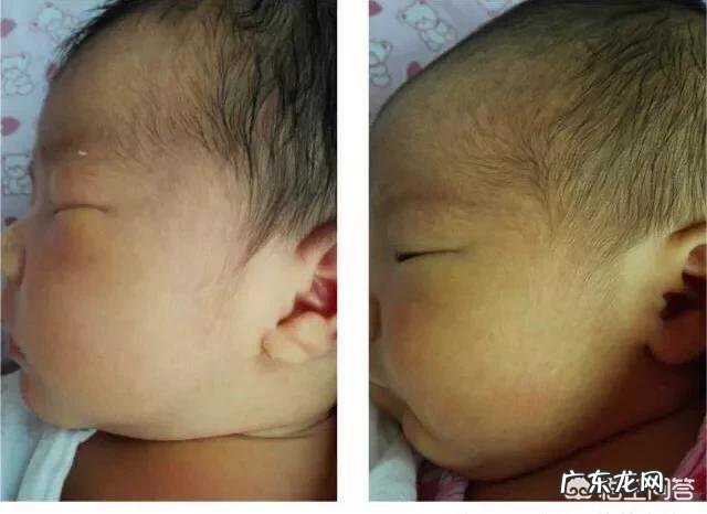 刚出生的婴儿有黄疸,怎么办是不是必须zhi疗啊