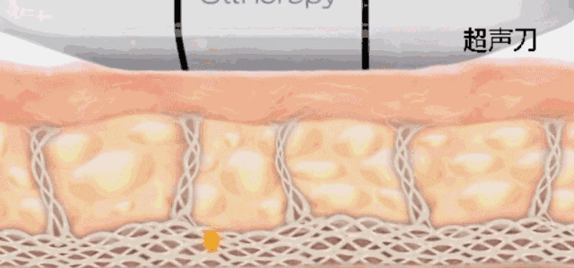 乳腺癌手术后怎么才能康复 乳腺癌的人术后怎样做康复？