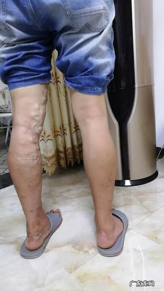 如何在日常生活中慢慢缓解静脉曲张？