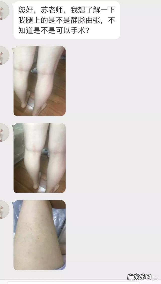 如何在日常生活中慢慢缓解静脉曲张？