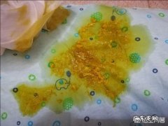 宝宝大便酸臭是乳糖不耐受吗 乳糖不耐受宝宝的大便是什么样的？