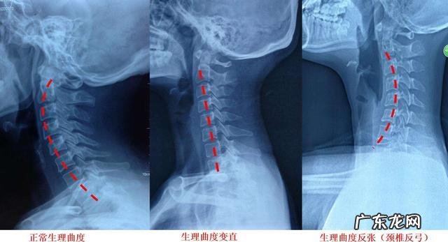 睡觉后肩颈酸痛是什么原因？