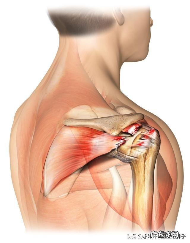 得了肩周炎,胳膊酸痛无法睡觉,该怎么办?