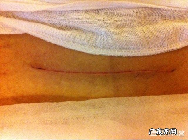 剖腹产的宝妈该怎么护理好伤口?什么时候开始收腹最好呢?