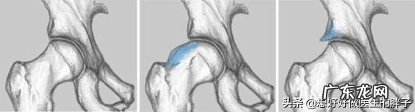 导致腰骶部疼痛的原因有哪些?