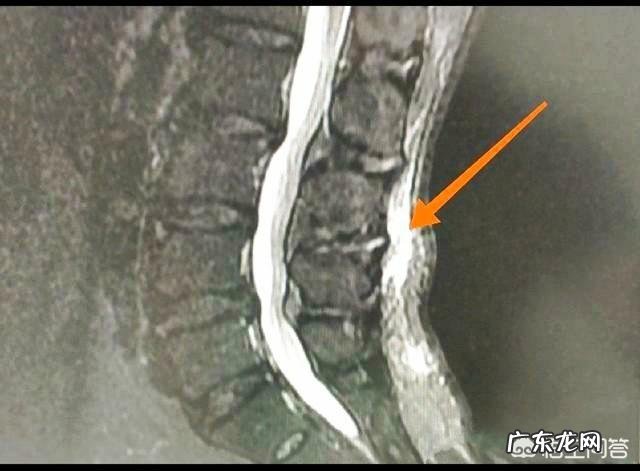 导致腰骶部疼痛的原因有哪些?