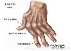 类风湿关节炎哪些食物不可以吃