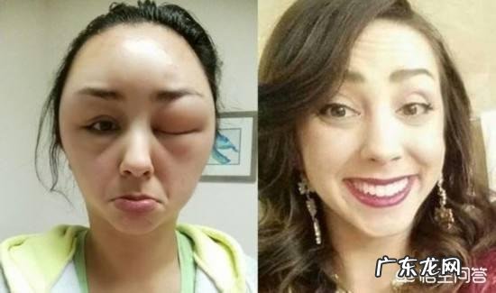 过敏体质的人不太容易得癌症,是真的吗