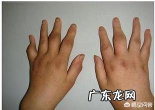 骨性关节炎用什么药 骨性关节炎轻微的疼活动一会就反而不疼,是什么原因?