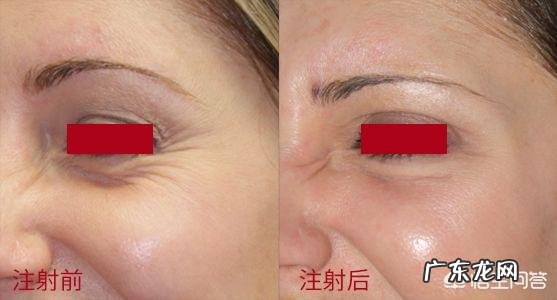 脸上去皱纹最好的方法是什么?