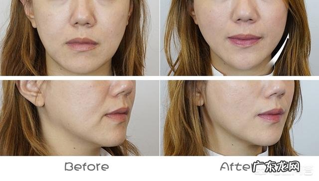 脸上去皱纹最好的方法是什么?