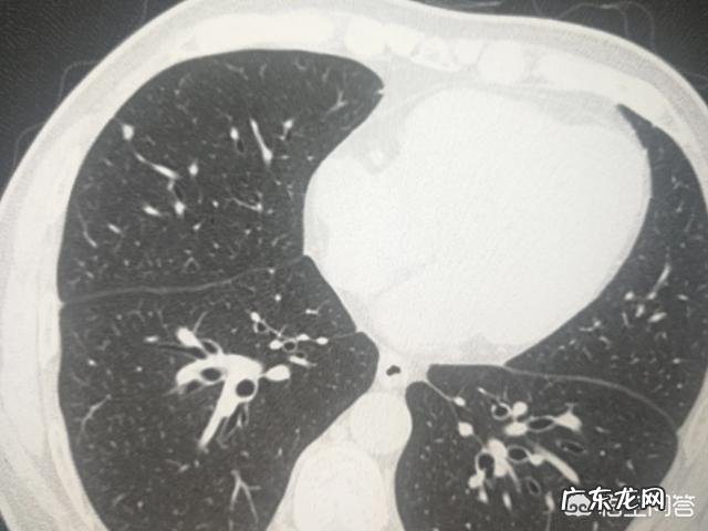 什么是结节?什么原因引起的呢?