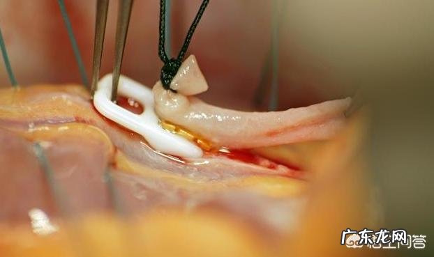 爱吃肉容易得高血脂,只吃素不吃肉,也会高血脂吗?