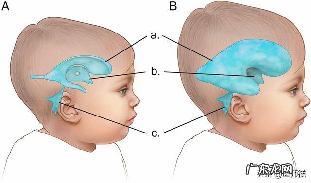 怀孕高血压会导致宝宝头大吗