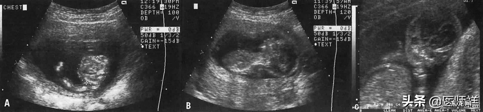 怀孕高血压会导致宝宝头大吗