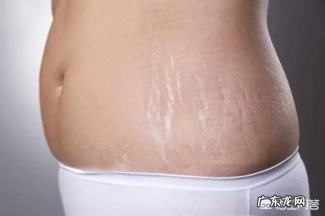 怀孕多久会长妊娠纹为什么会长妊娠纹
