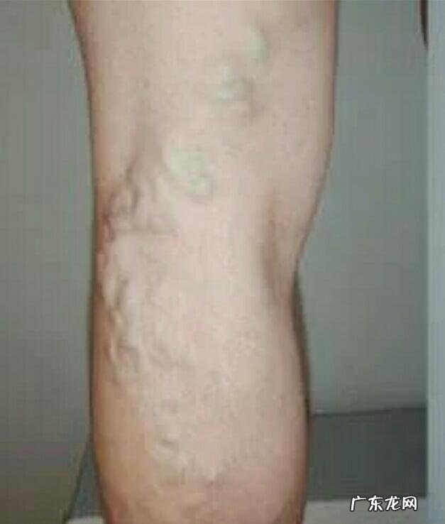 有什么好办法可以缓解静脉曲张吗?