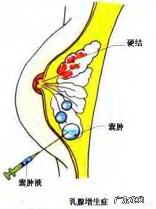 腋下和乳房连着痛是什么原因?