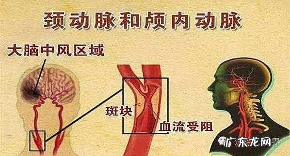 动脉有斑块后需要服降脂药吗?