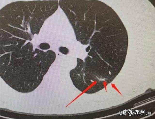 身体湿气重,用什么方法去除好?