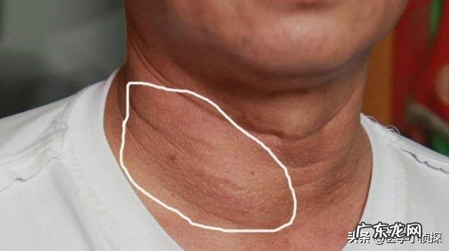 身体湿气重，用什么方法去除好？