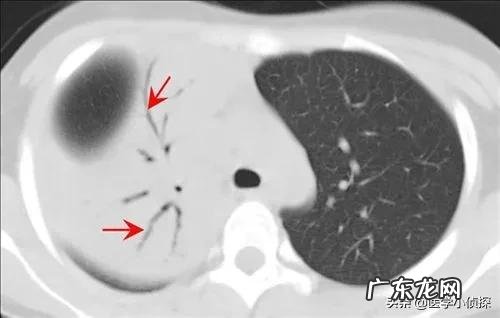 身体湿气重，用什么方法去除好？