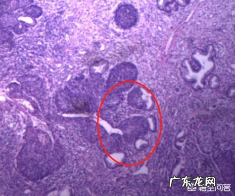 腺体肠化伴中重度增生严重吗?