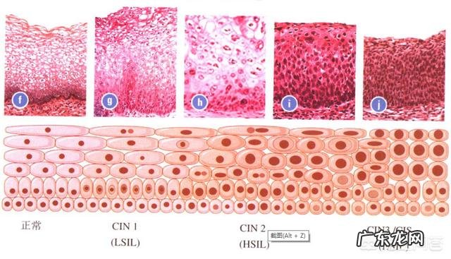 腺体肠化伴中重度增生严重吗?