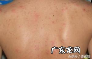 为什么后背会长小疙瘩、痘痘？
