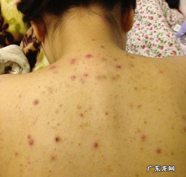 为什么后背会长小疙瘩、痘痘？