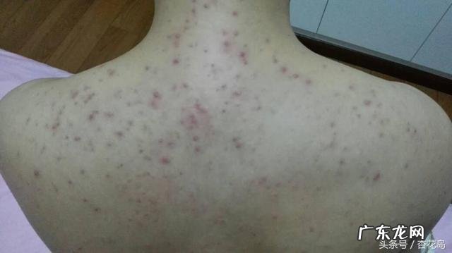 为什么后背会长小疙瘩、痘痘？