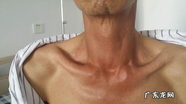 23岁眼下有细纹还微微凸起,是不是眼袋,怎么恢复啊?