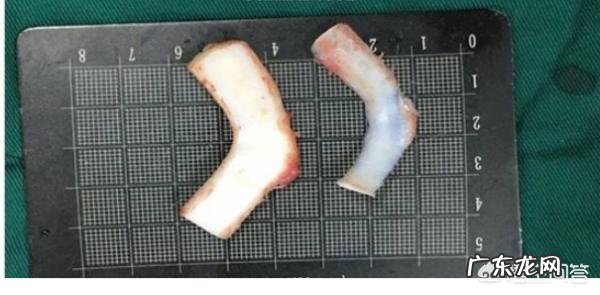 肋骨隆鼻后,肋骨会被吸收吗?原因是什么?需要注意哪些问题?