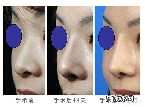 肋骨隆鼻后,肋骨会被吸收吗?原因是什么?需要注意哪些问题?