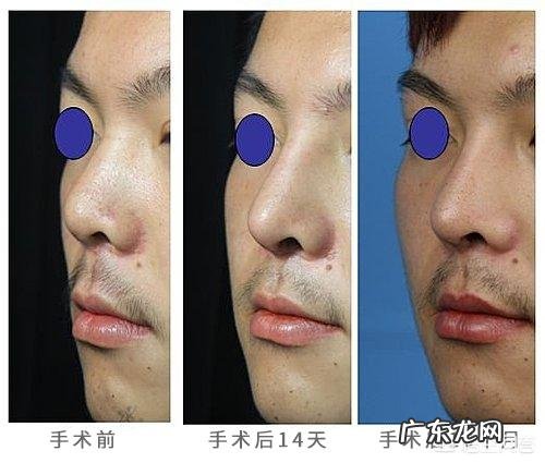 肋骨隆鼻后,肋骨会被吸收吗?原因是什么?需要注意哪些问题?