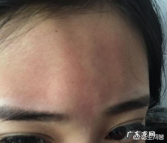 长期打玻尿酸会有后遗症吗?