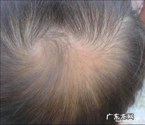 洗头掉下来的头发是本来就要掉的吗