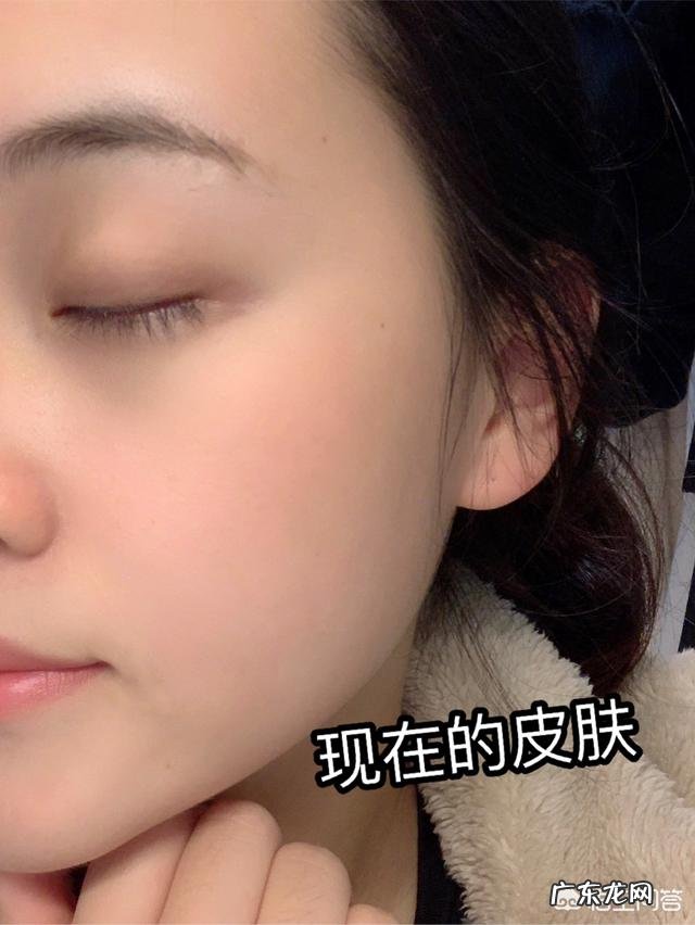 敏感肌容易过敏，经常长痘痘和闭口，是清洁不彻底吗