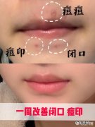 敏感肌容易过敏，经常长痘痘和闭口，是清洁不彻底吗