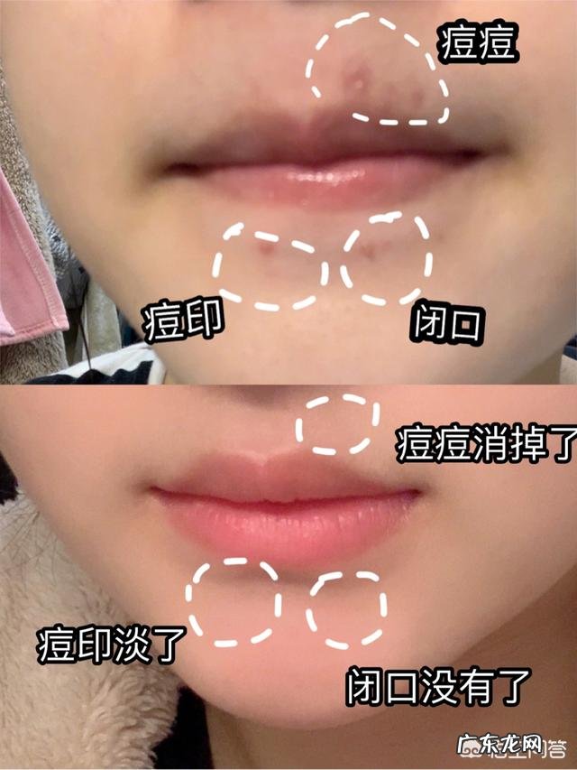 敏感肌容易过敏，经常长痘痘和闭口，是清洁不彻底吗