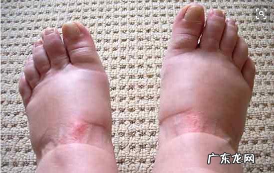 水肿型肥胖要怎么瘦 不吃药的情况下怎么样做才可以去掉水肿型肥胖？