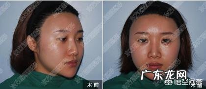 硅胶假体隆鼻失败后,要如何修复?