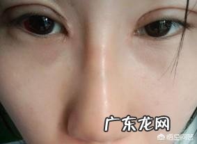 硅胶假体隆鼻失败后,要如何修复?