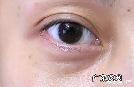 填充泪沟要注意什么,有哪些好的建议?