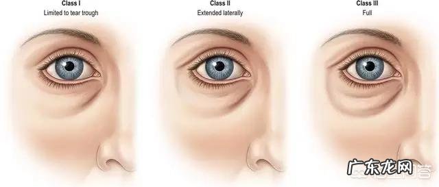 填充泪沟要注意什么,有哪些好的建议?