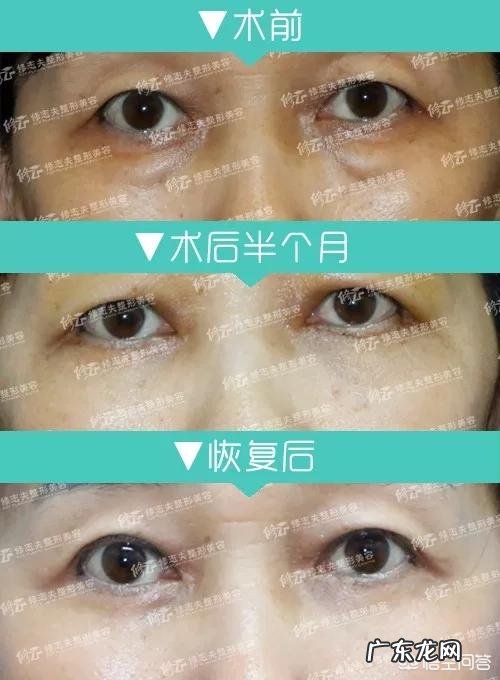 填充泪沟要注意什么,有哪些好的建议?