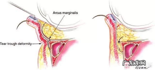 填充泪沟要注意什么,有哪些好的建议?